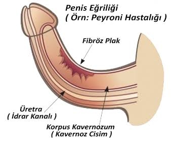 Peyronie Yeni İlaç